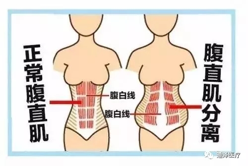 你知道腹直肌分離是什么嗎？