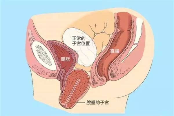 【產(chǎn)后修復(fù)】盆腔臟器脫垂，你有嗎？