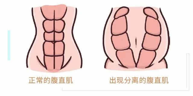 腹直肌修復(fù)電極，硅膠電極的特點(diǎn)