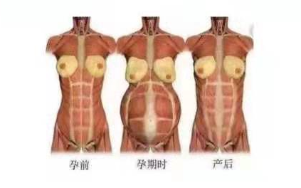 小巧便攜式產(chǎn)后康復(fù)治療儀，跟腹直肌分離說拜拜
