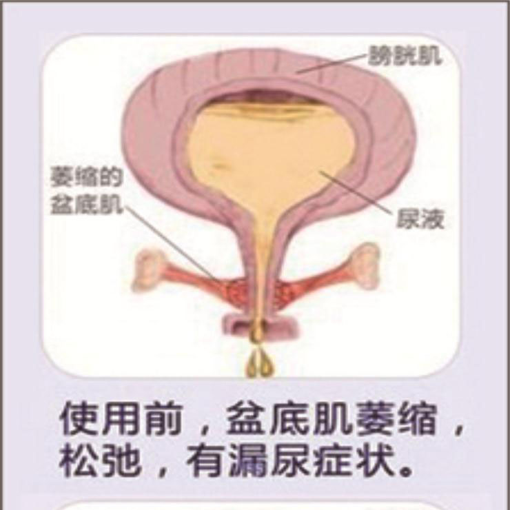 產(chǎn)后盆底肌康復(fù)|“社交癌”盯上你了嗎？