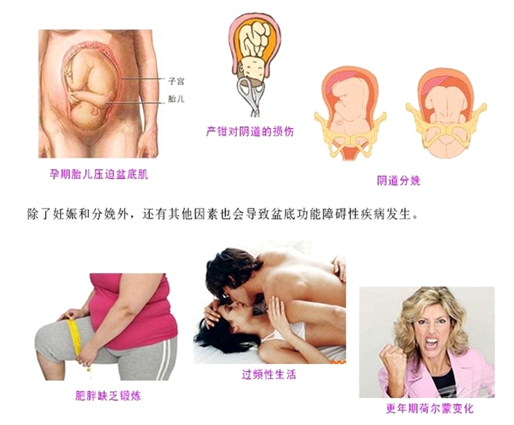 產(chǎn)后康復(fù)治療很重要，慢性盆腔痛很重要