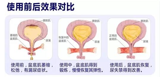 盆底康復治療怎么做？產后盆底功能檢測很重要