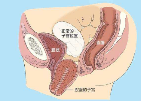 人們常說，產(chǎn)后女性做好盆底肌修復是關(guān)鍵，但盆腔器官的脫垂你也得注意