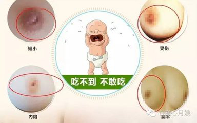 產(chǎn)后恢復(fù)為什么需要催乳儀器？