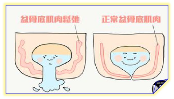 盆底康復(fù)治療怎么做，盆底肌修復(fù)常見(jiàn)的十大問(wèn)題（中）