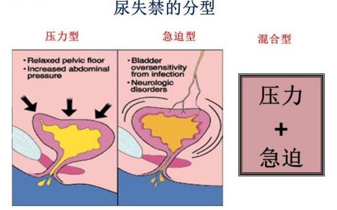 產(chǎn)后盆底肌怎么修復(fù)|尿失禁的類型，傻傻分不清