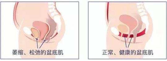 尿失禁治療儀器，不再詢問盆底康復(fù)治療有用嗎這類無意義問題
