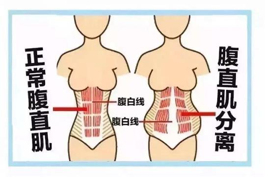 你所不知道的產(chǎn)后腹直肌如何康復(fù)，通澤產(chǎn)康為您解答