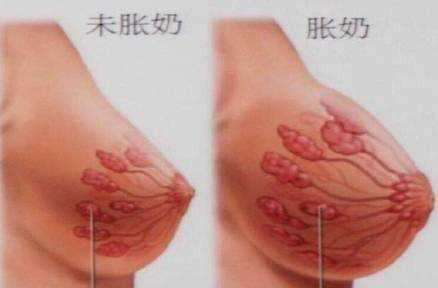 緩解漲奶，產(chǎn)后康復(fù)治療儀廠家?guī)椭a(chǎn)康門店解決乳腺疏通問題