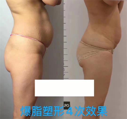 產(chǎn)后塑形美雕儀，生完孩子真的很難恢復(fù)身材？未必……