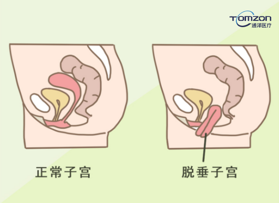 你害怕子宮脫垂嗎？盆底肌修復(fù)儀器來拯救你