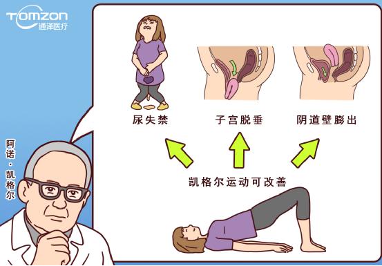使用凱格爾球還能做盆底治療儀嗎？